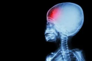 car accident brain injuries Fort Lauderdale, FL